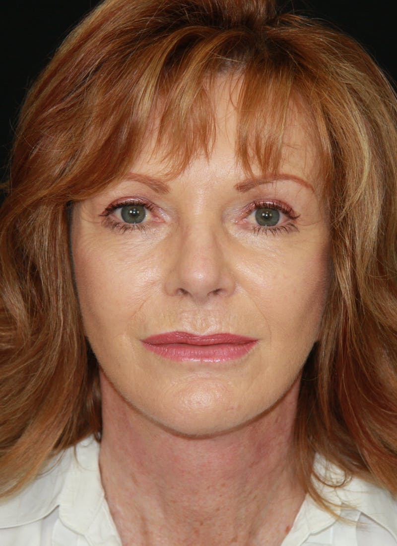Facelift & Neck Lift Before & After Gallery - Patient 173364514 - Image 2