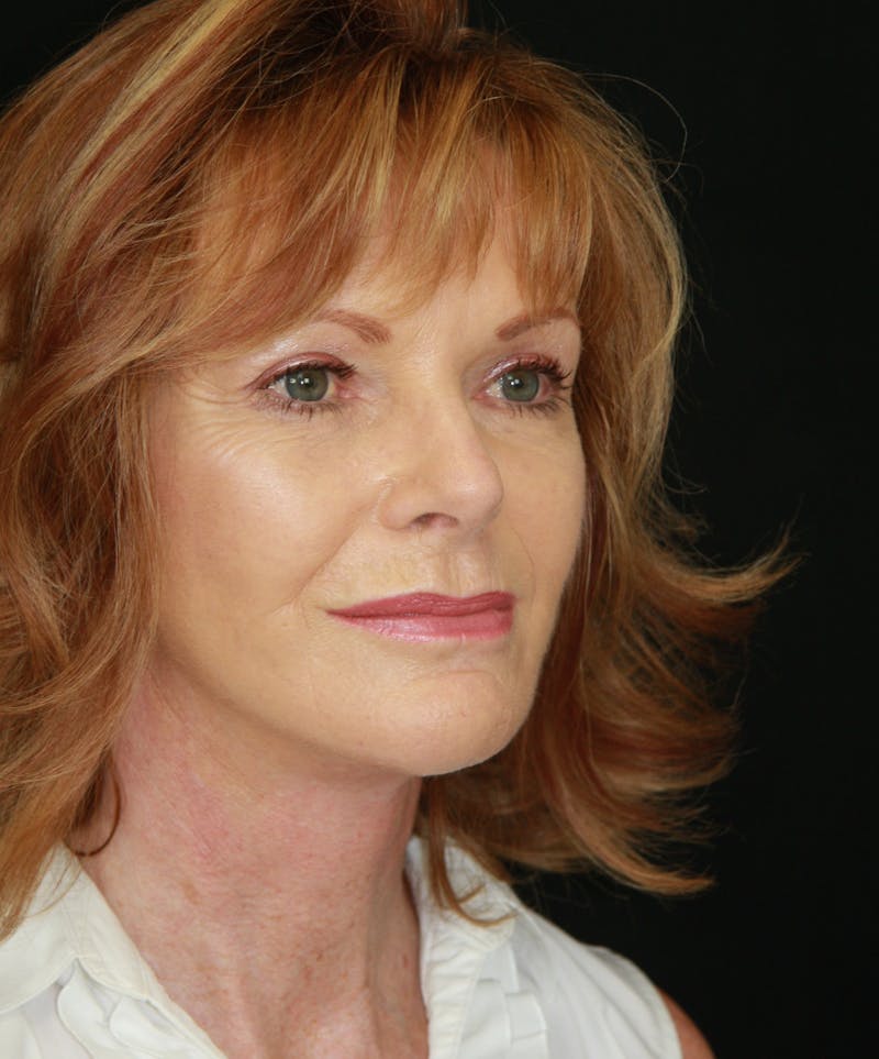 Facelift & Neck Lift Before & After Gallery - Patient 173364514 - Image 4