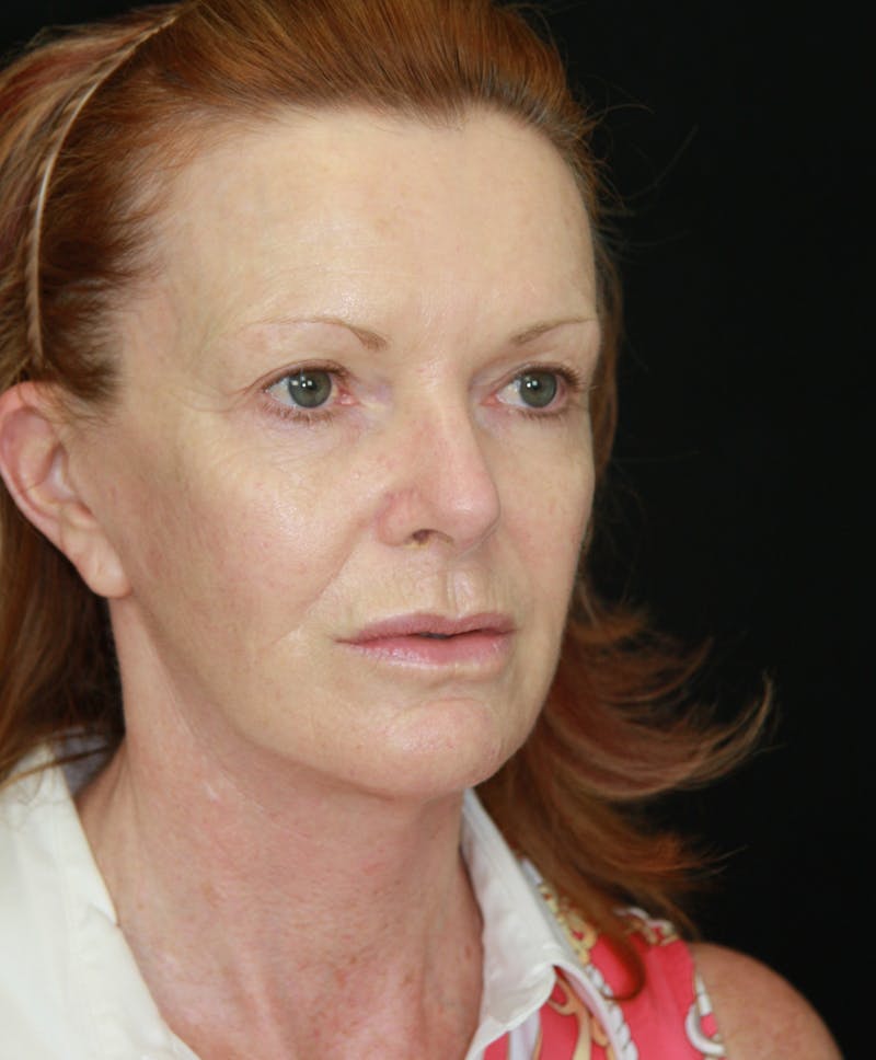 Facelift & Neck Lift Before & After Gallery - Patient 173364514 - Image 3