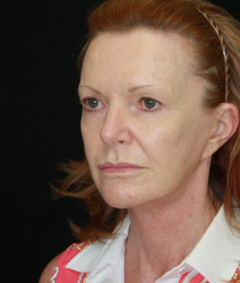 Facelift & Neck Lift Before & After Gallery - Patient 173364514 - Image 5