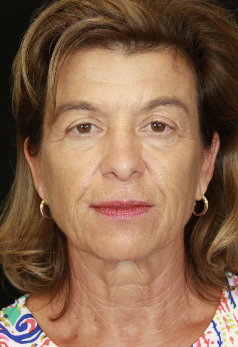 Facelift & Neck Lift Before & After Gallery - Patient 173364594 - Image 1