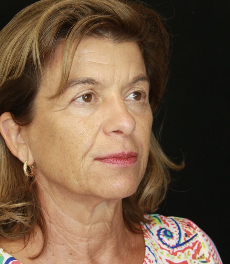 Facelift & Neck Lift Before & After Gallery - Patient 173364594 - Image 3