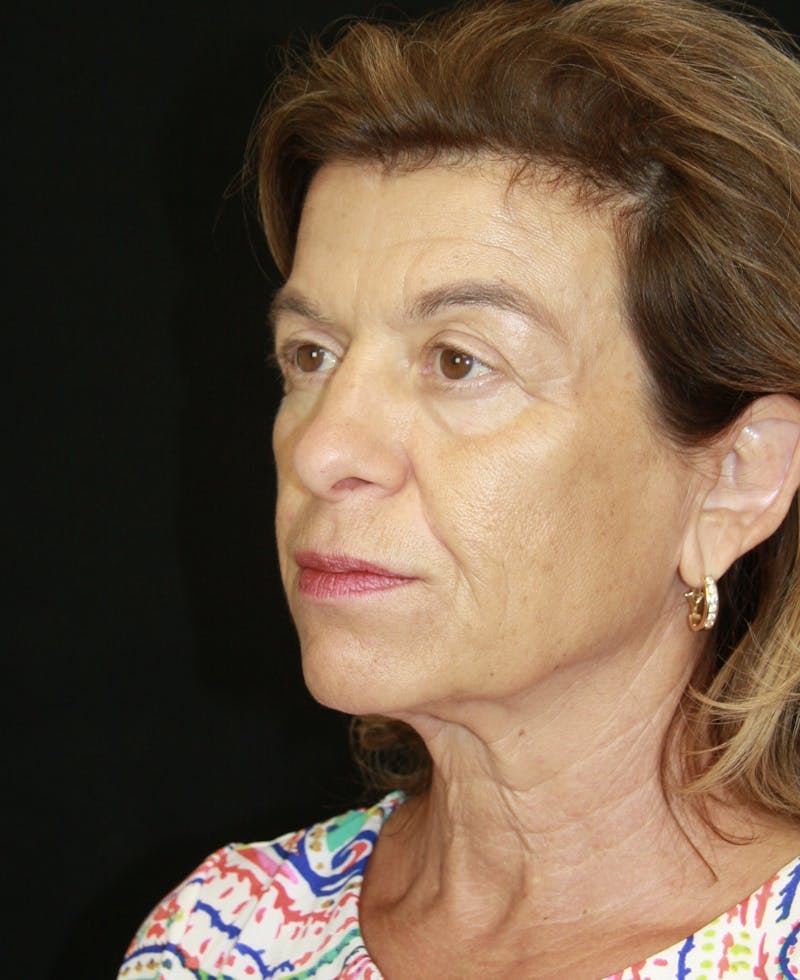 Facelift & Neck Lift Before & After Gallery - Patient 173364594 - Image 5
