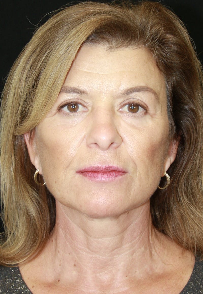Facelift & Neck Lift Before & After Gallery - Patient 173364594 - Image 2