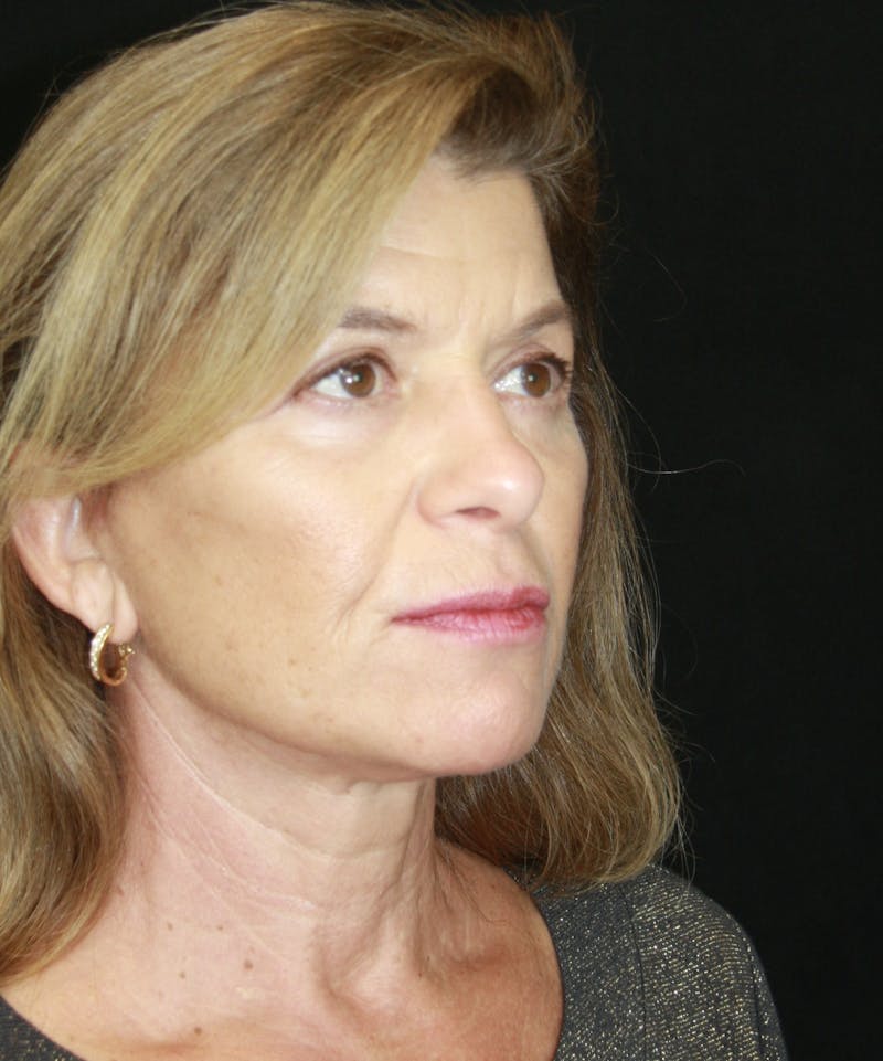 Facelift & Neck Lift Before & After Gallery - Patient 173364594 - Image 4