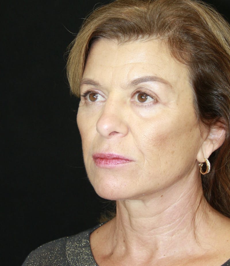 Facelift & Neck Lift Before & After Gallery - Patient 173364594 - Image 6