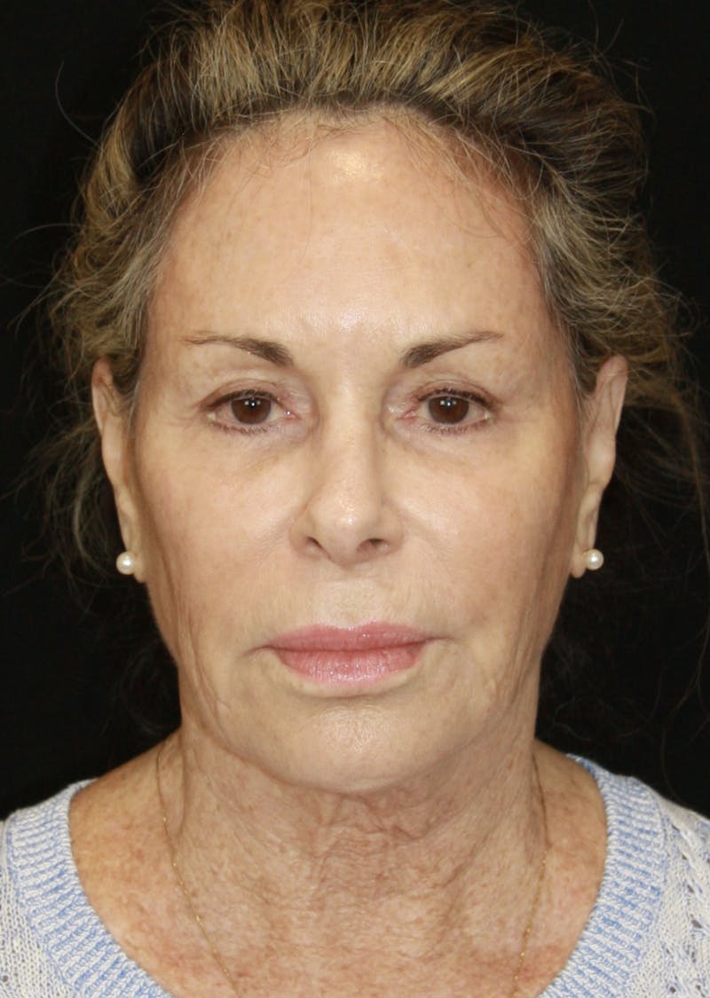 Facelift & Neck Lift Before & After Gallery - Patient 173364626 - Image 1