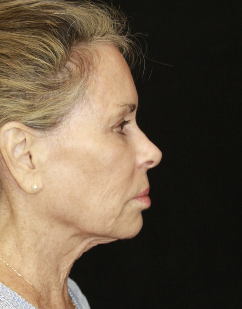 Facelift & Neck Lift Before & After Gallery - Patient 173364626 - Image 5