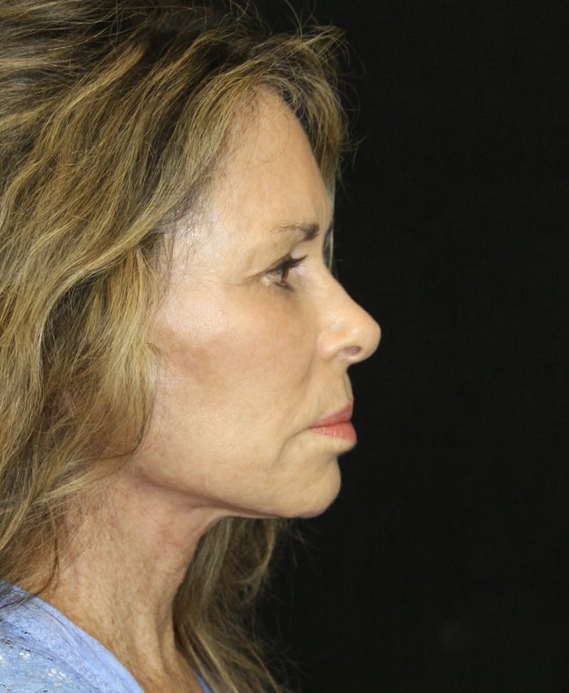 Facelift & Neck Lift Before & After Gallery - Patient 173364626 - Image 6