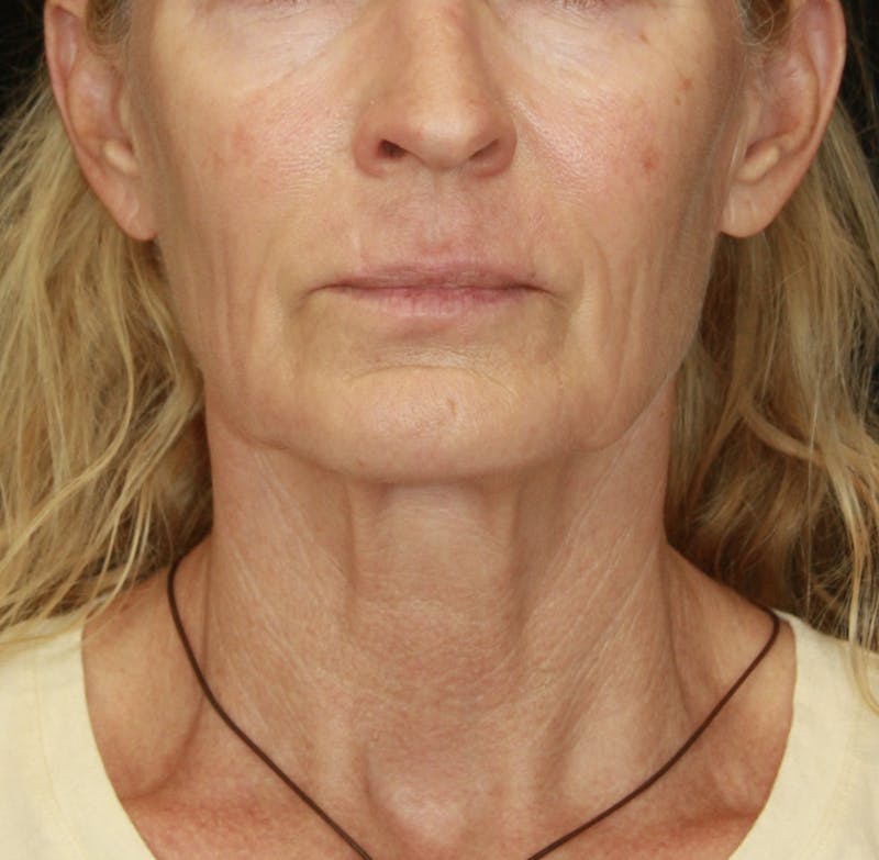 Facelift & Neck Lift Before & After Gallery - Patient 173367774 - Image 1