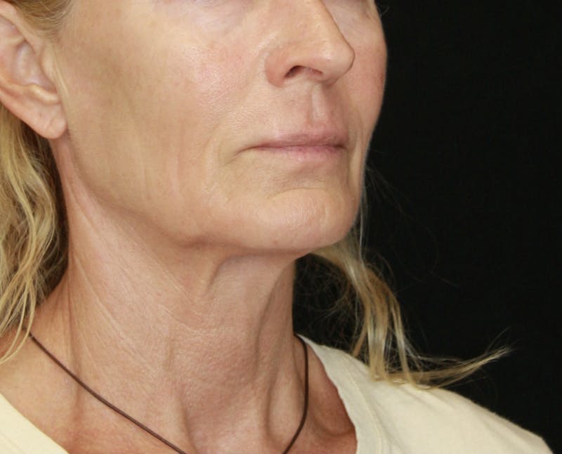 Facelift & Neck Lift Before & After Gallery - Patient 173367774 - Image 3