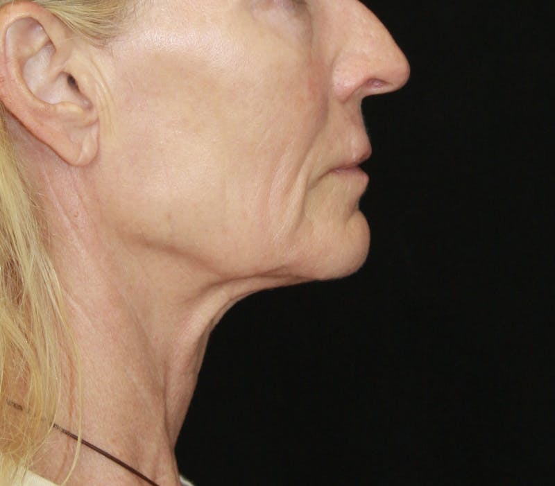 Facelift & Neck Lift Before & After Gallery - Patient 173367774 - Image 5