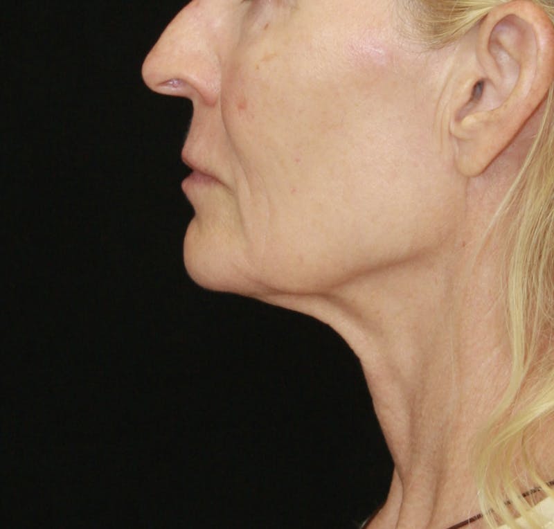 Facelift & Neck Lift Before & After Gallery - Patient 173367774 - Image 7