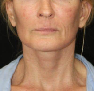 Facelift & Neck Lift Before & After Gallery - Patient 173367774 - Image 2