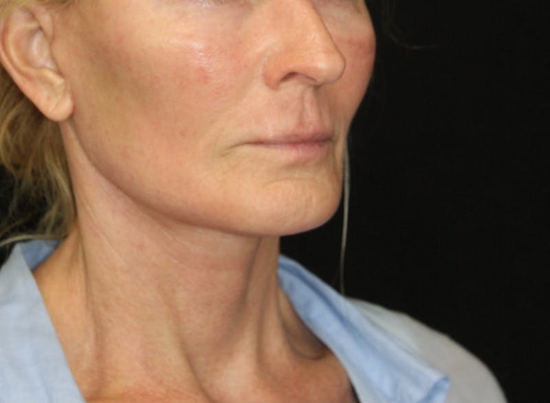 Facelift & Neck Lift Before & After Gallery - Patient 173367774 - Image 4
