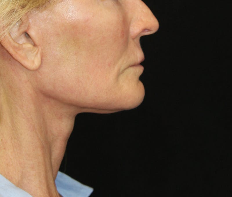 Facelift & Neck Lift Before & After Gallery - Patient 173367774 - Image 6