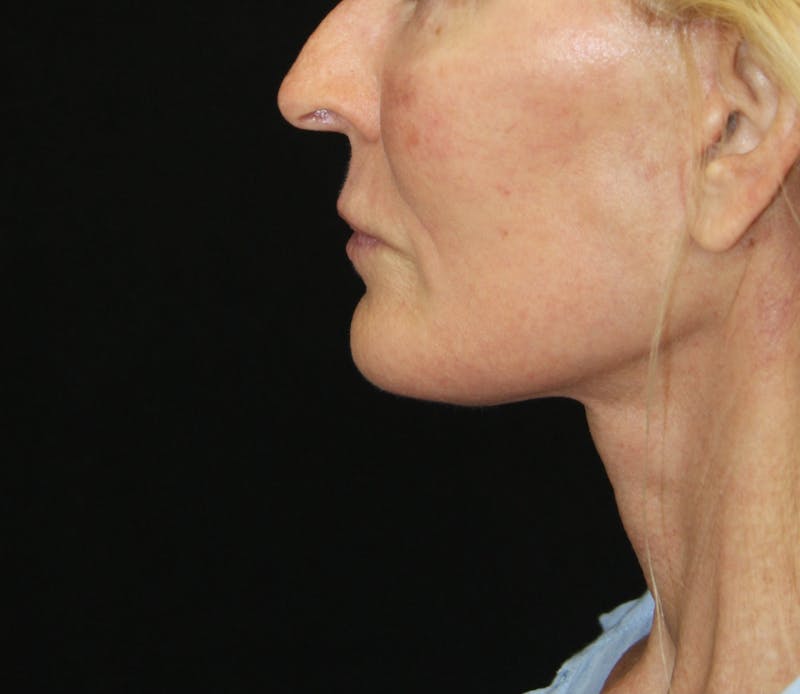 Facelift & Neck Lift Before & After Gallery - Patient 173367774 - Image 8