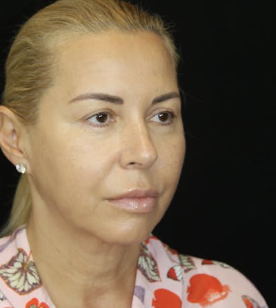 Facelift & Neck Lift Before & After Gallery - Patient 173368472 - Image 1