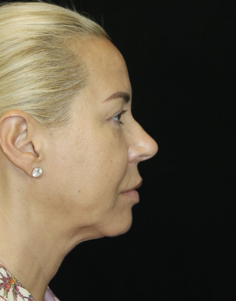 Facelift & Neck Lift Before & After Gallery - Patient 173368472 - Image 3