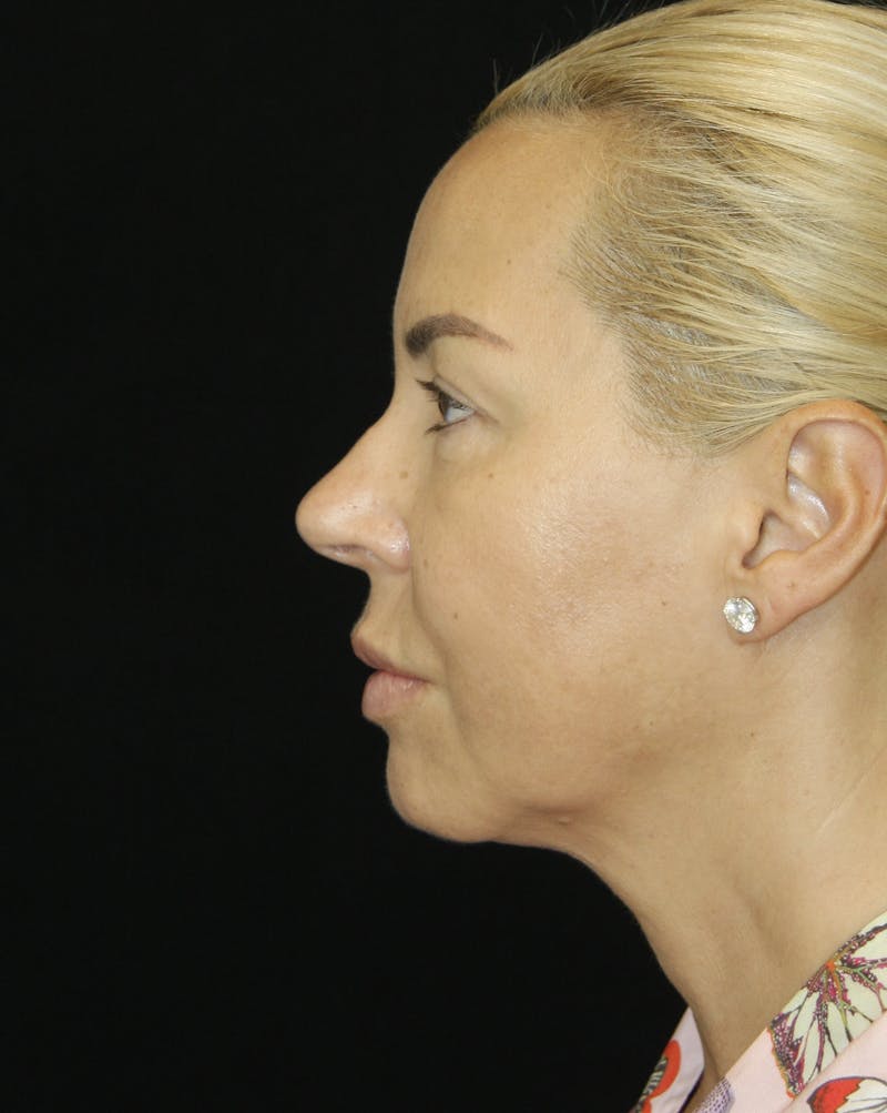 Facelift & Neck Lift Before & After Gallery - Patient 173368472 - Image 7