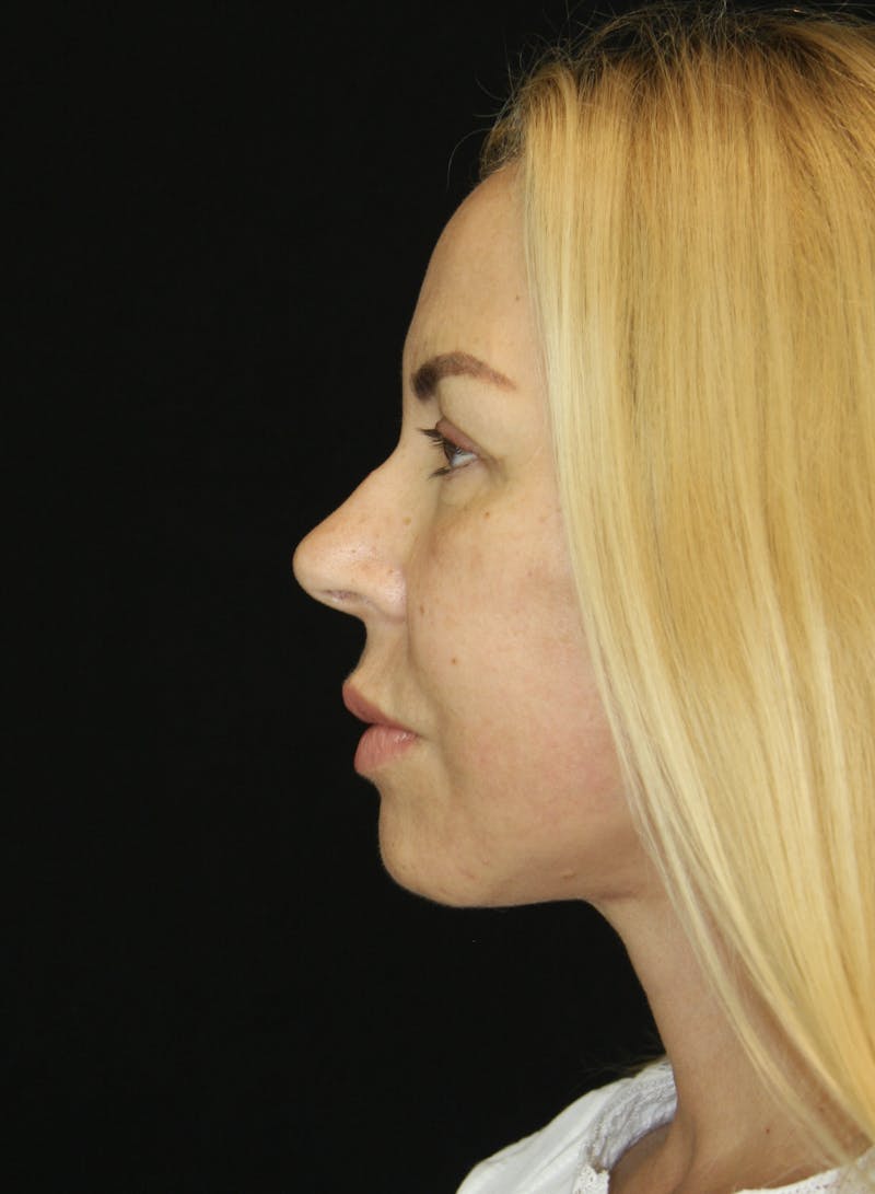 Facelift & Neck Lift Before & After Gallery - Patient 173368472 - Image 8