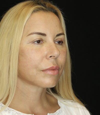 Facelift & Neck Lift Before & After Gallery - Patient 173368472 - Image 2