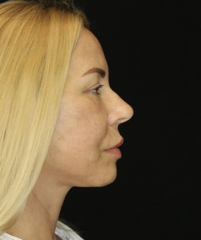Facelift & Neck Lift Before & After Gallery - Patient 173368472 - Image 4