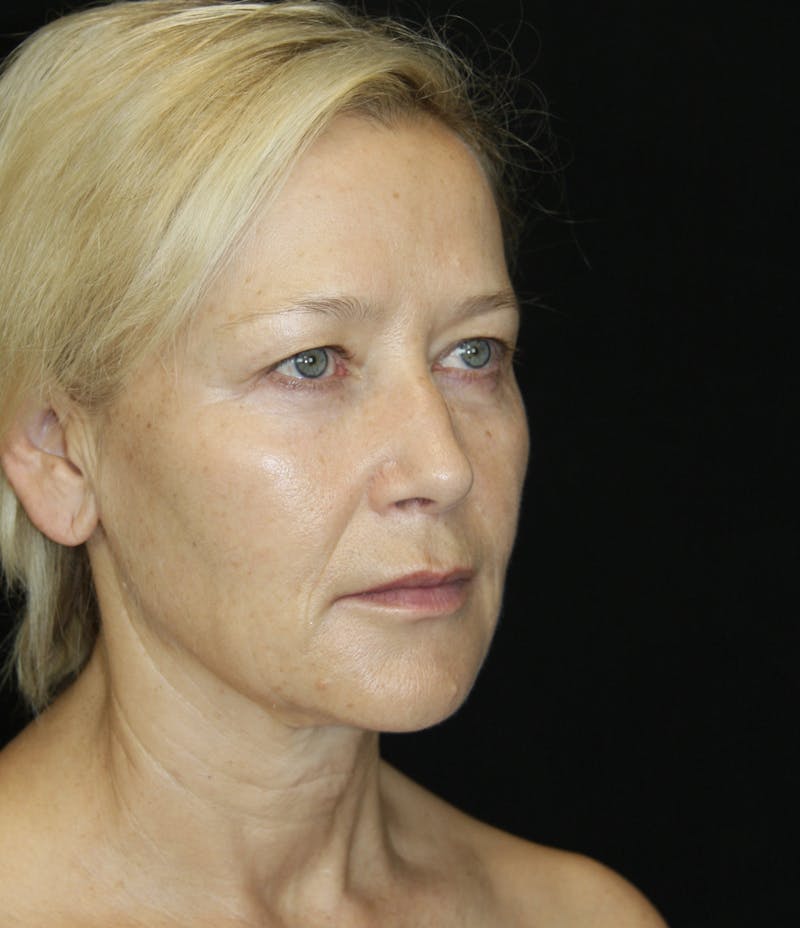 Facelift & Neck Lift Before & After Gallery - Patient 173368544 - Image 5