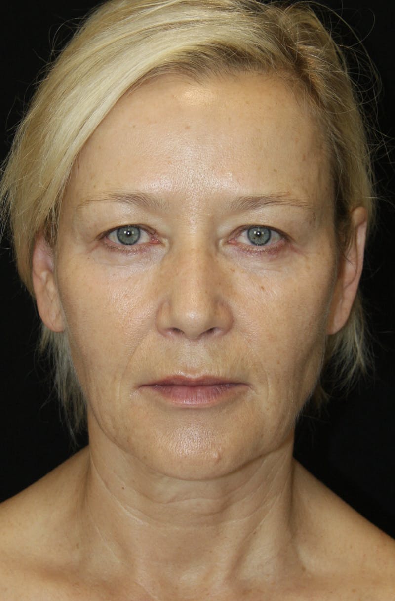 Facelift & Neck Lift Before & After Gallery - Patient 173368544 - Image 1