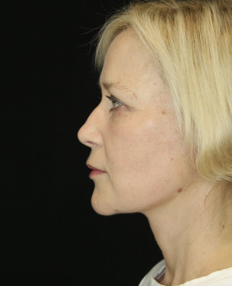 Facelift & Neck Lift Before & After Gallery - Patient 173368544 - Image 4