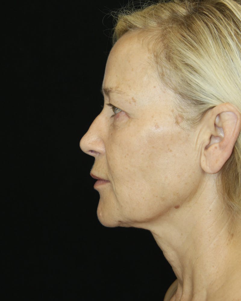 Facelift & Neck Lift Before & After Gallery - Patient 173368544 - Image 3