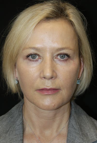 Facelift & Neck Lift Before & After Gallery - Patient 173368544 - Image 2