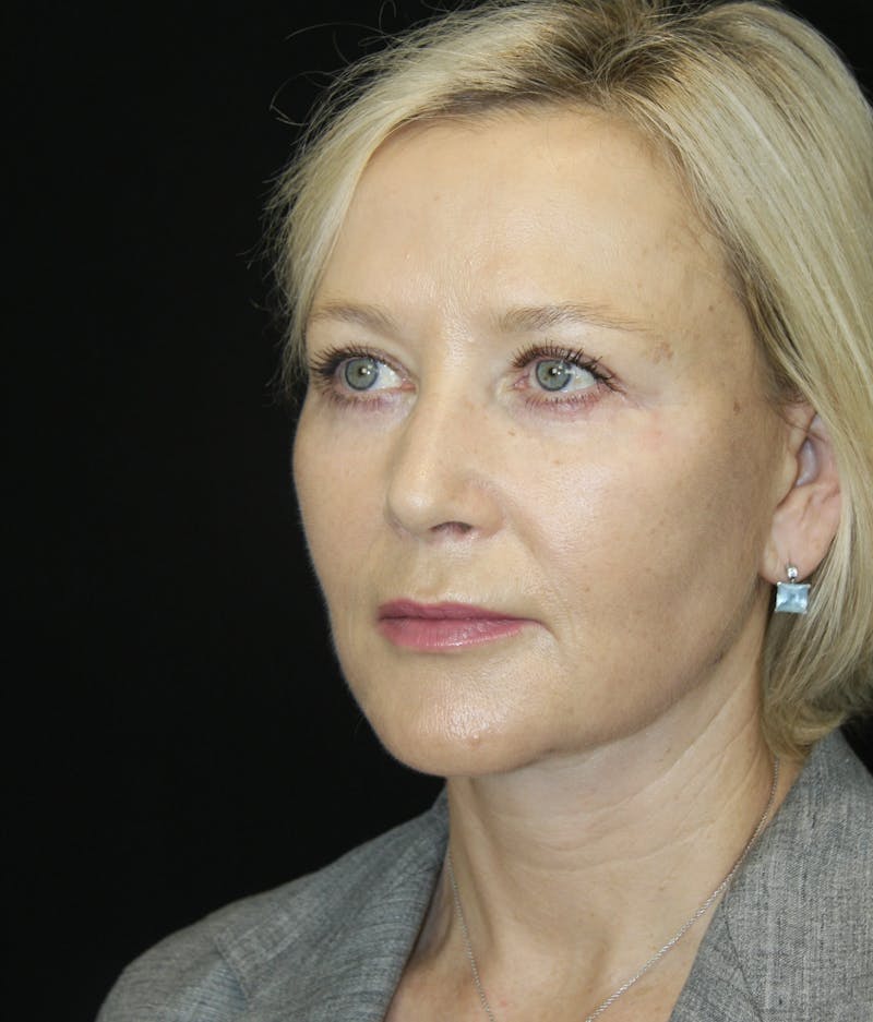 Facelift & Neck Lift Before & After Gallery - Patient 173368544 - Image 6
