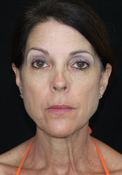 Facelift & Neck Lift Before & After Gallery - Patient 173371980 - Image 1