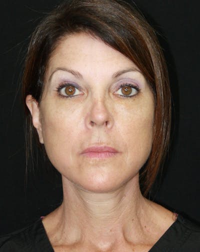 Facelift & Neck Lift Before & After Gallery - Patient 173371980 - Image 2