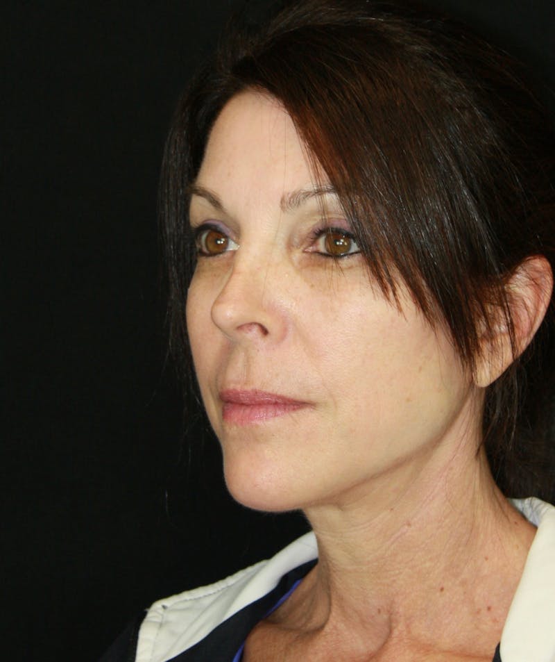 Facelift & Neck Lift Before & After Gallery - Patient 173371980 - Image 4