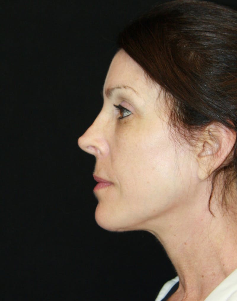 Facelift & Neck Lift Before & After Gallery - Patient 173371980 - Image 6