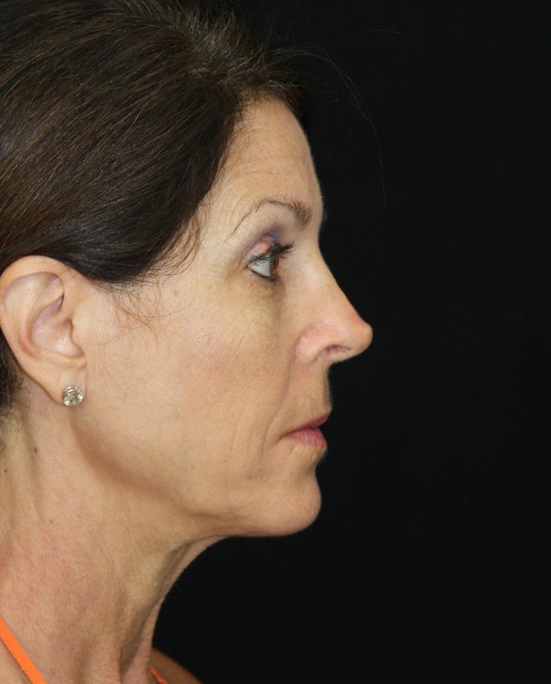Facelift & Neck Lift Before & After Gallery - Patient 173371980 - Image 7