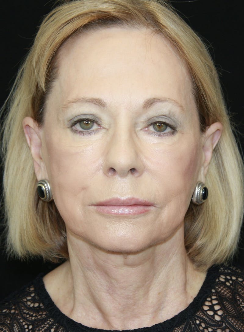 Facelift & Neck Lift Before & After Gallery - Patient 173372045 - Image 1