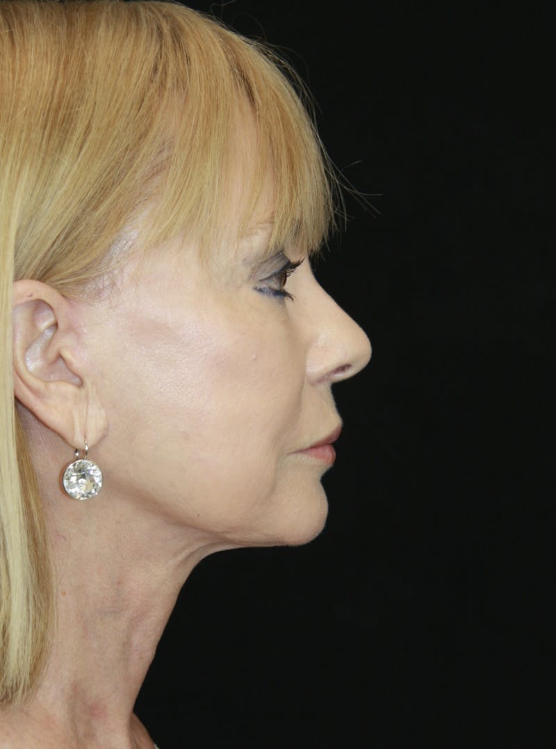 Facelift & Neck Lift Before & After Gallery - Patient 173372045 - Image 6