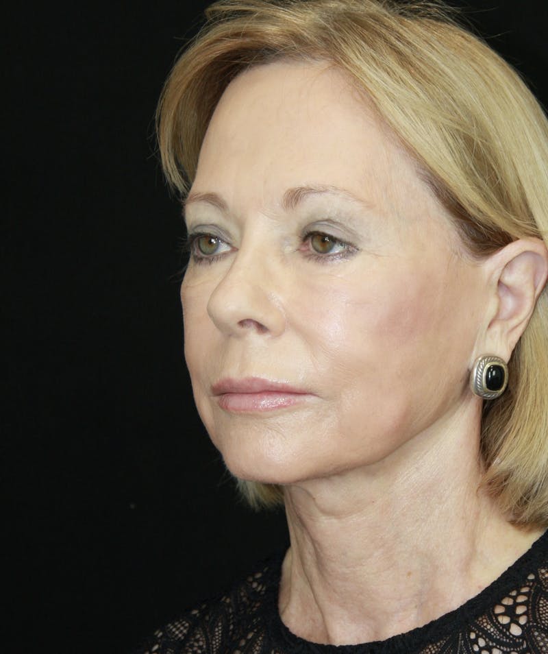 Facelift & Neck Lift Before & After Gallery - Patient 173372045 - Image 7