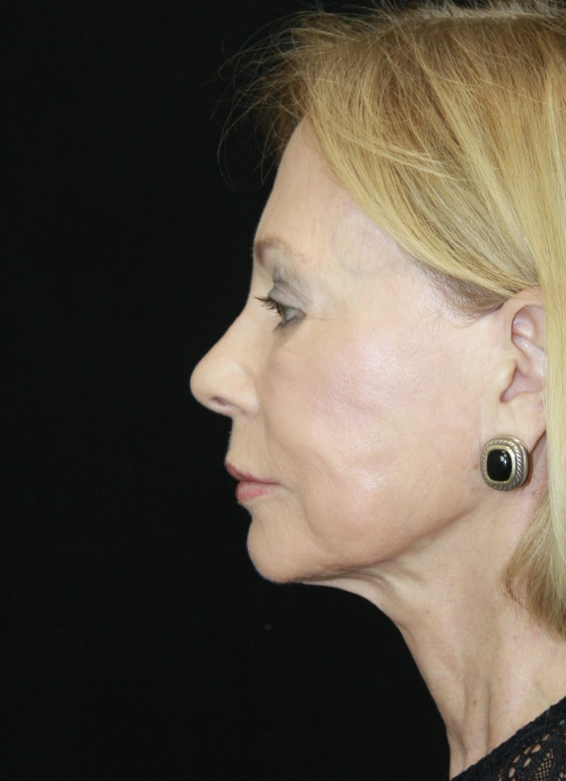 Facelift & Neck Lift Before & After Gallery - Patient 173372045 - Image 9