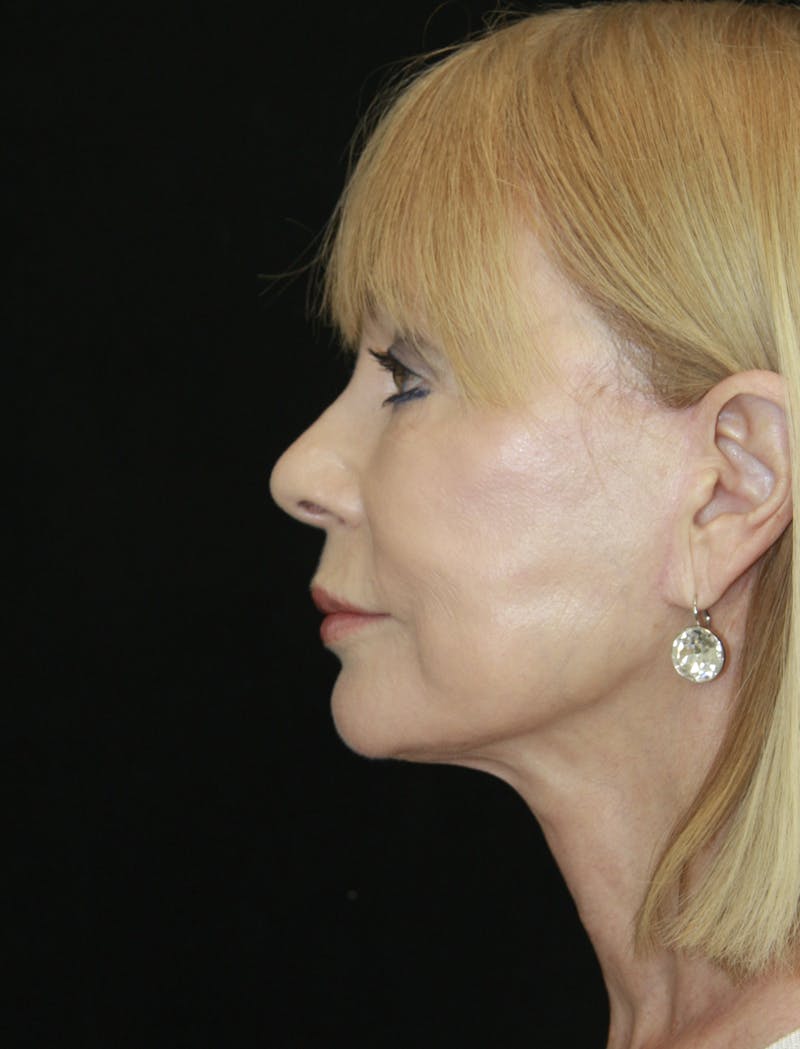 Facelift & Neck Lift Before & After Gallery - Patient 173372045 - Image 10