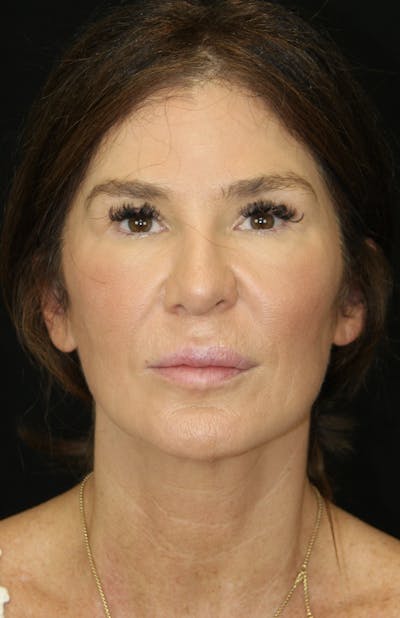Facelift & Neck Lift Before & After Gallery - Patient 173372073 - Image 1