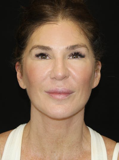 Facelift & Neck Lift Before & After Gallery - Patient 173372073 - Image 2