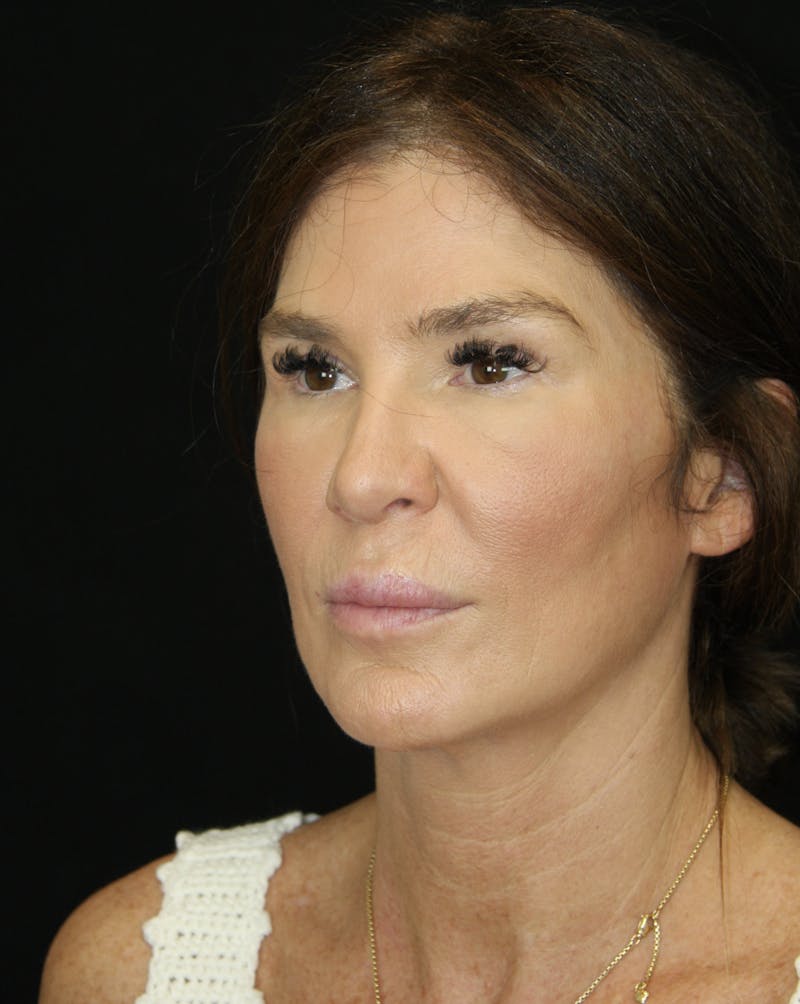 Facelift & Neck Lift Before & After Gallery - Patient 173372073 - Image 3