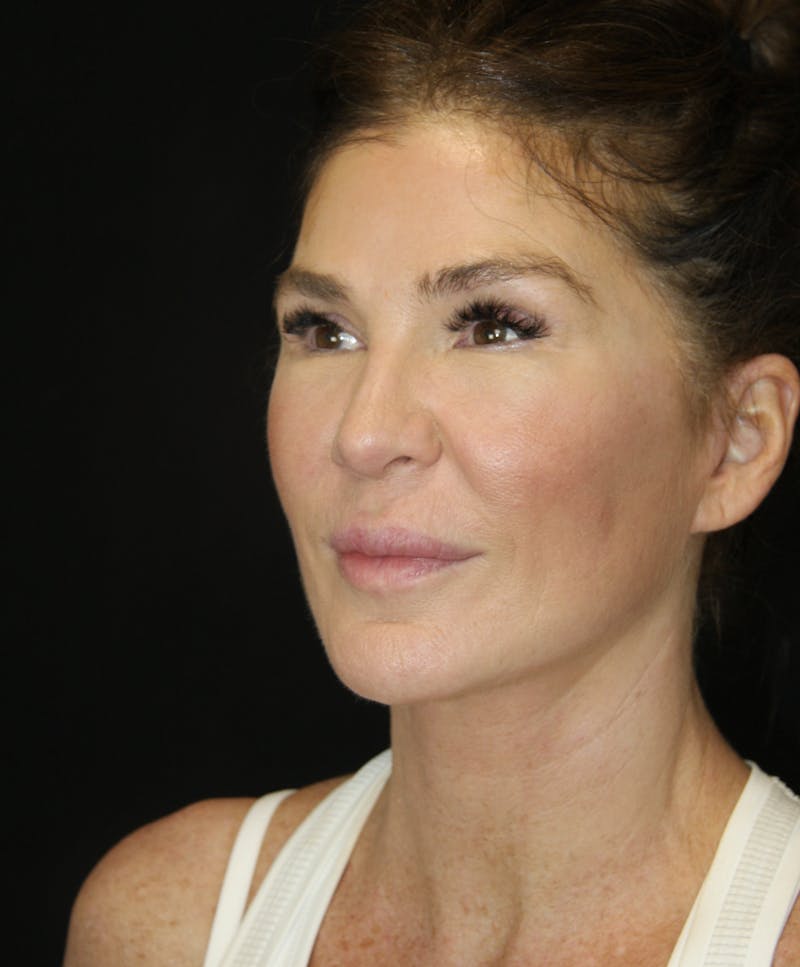 Facelift & Neck Lift Before & After Gallery - Patient 173372073 - Image 4
