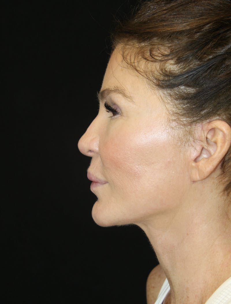 Facelift & Neck Lift Before & After Gallery - Patient 173372073 - Image 6