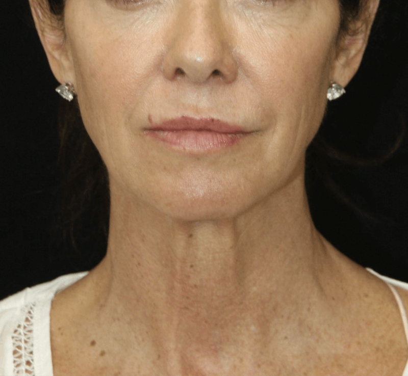 Facelift & Neck Lift Before & After Gallery - Patient 173372092 - Image 1
