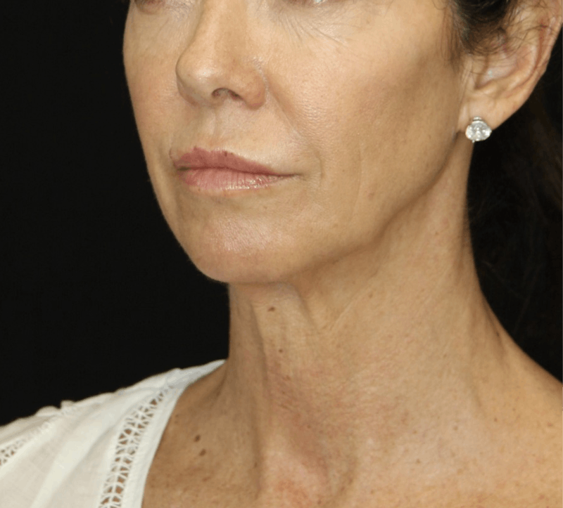 Facelift & Neck Lift Before & After Gallery - Patient 173372092 - Image 3
